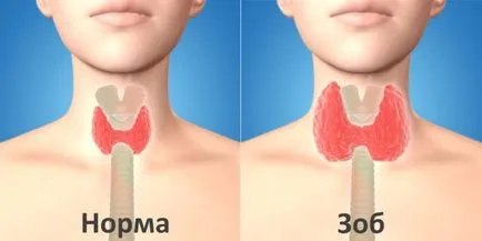 Creșterea simptome tiroidiene