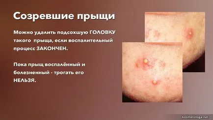 Ce ar trebui să fac în cazul în care comedon pocniți