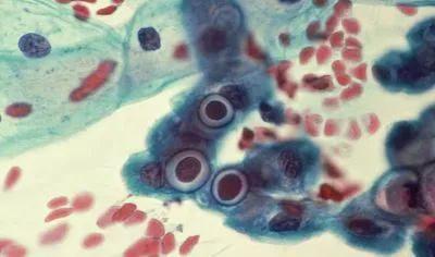 Chlamydia si sarcina de tratament Chlamydia si sarcina de tratament