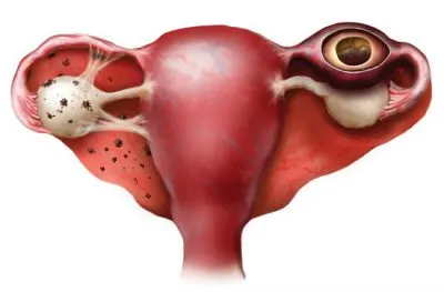 Chlamydia si sarcina de tratament Chlamydia si sarcina de tratament