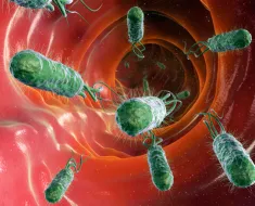 Ce este pneumonia congestiv
