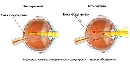 Astigmatismul la copii ce este