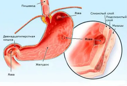 Ca o durere de stomac dupa masa Ca o durere de stomac dupa masa