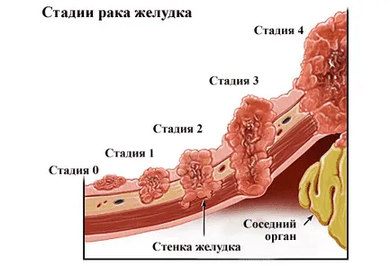 Ca o durere de stomac dupa masa