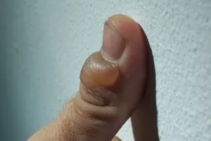 Cum să scapi de blistere