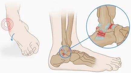 Ce se poate face în cazul în care ligamentele luxat
