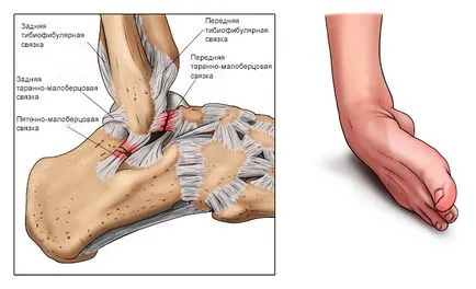 Ce se poate face în cazul în care ligamentele luxat