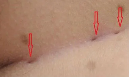 Din cauza a ceea ce chistului coccisul