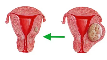 Tratamentul chisturi endocervical