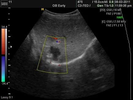 Tratamentul chisturi endocervical