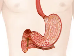 Gastroduodenit cum de a vindeca Gastroduodenit cum de a vindeca
