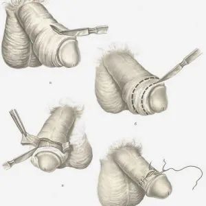 Fimoza trata