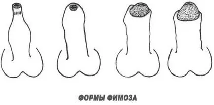 Fimoza trata Fimoza trata