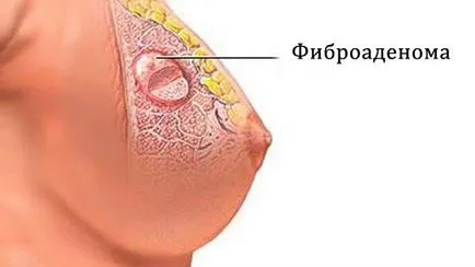tratament de san Fibroadenomatosis