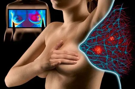 tratament de san Fibroadenomatosis