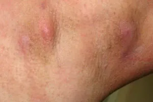 Inflamația axila, care este Inflamația axila, care este