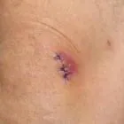 Ce se întâmplă dacă infecția a intrat în
