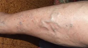 Cum de a elimina durerea la nivelul picioarelor