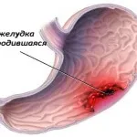 Schema de tratament a ulcerului gastric