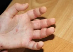 Cum să scapi de blistere Cum să scapi de blistere