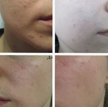 Cum sa faci un peeling acasă