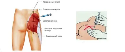 Cum de a se pune în injecțiile fesa
