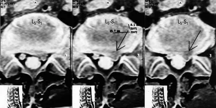 Tratament Herniile intervertebrale fără o intervenție chirurgicală