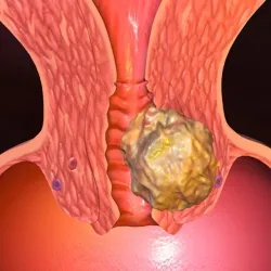 Tratamentul chisturi endocervical