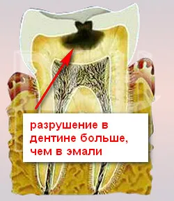 Cariile de dentinei