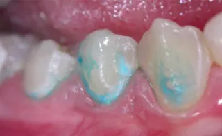 Cariile de dentinei