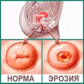 Tratamentul chisturi endocervical