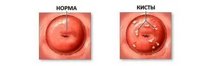 Tratamentul chisturi endocervical
