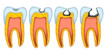 Cariile de dentinei