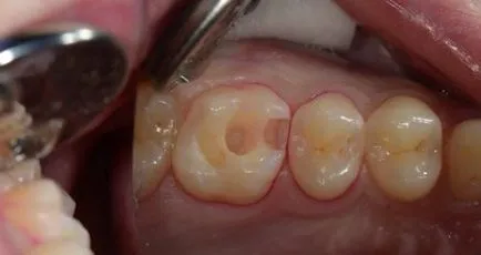 Cariile de dentinei