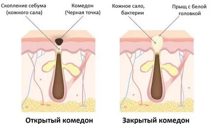 Ce este comedoane pe fata Ce este comedoane pe fata