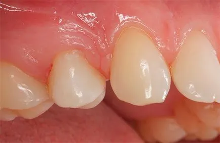 Cariile de dentinei