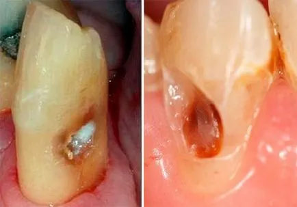 Cariile de dentinei