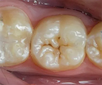 Cariile de dentinei