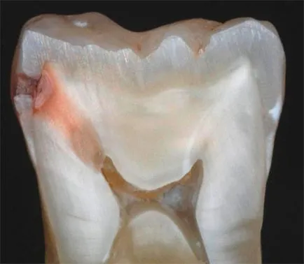 Cariile de dentinei