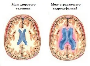 remedii populare hidrocefalia Tratament