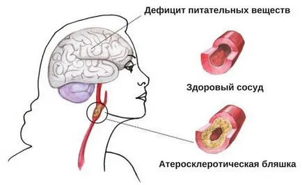 Scăderea tensiunii arteriale este ceea ce este Scăderea tensiunii arteriale este ceea ce este