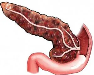 Ce este pancreatita pancreasului Ce este pancreatita pancreasului