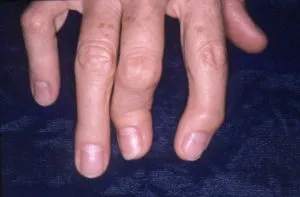 tratamentul polyosteoarthrosis