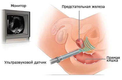 pregătire de prostată Uzi