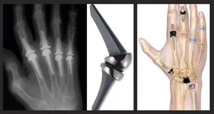 tratamentul polyosteoarthrosis