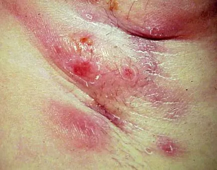 Inflamația axila, care este Inflamația axila, care este