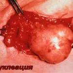 tratament de san Fibroadenomatosis tratament de san Fibroadenomatosis