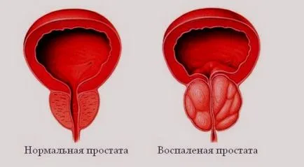 Simptomele prostatita la bărbați