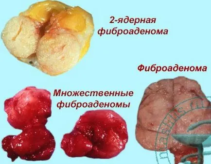 tratament de san Fibroadenomatosis tratament de san Fibroadenomatosis