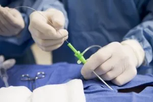 Stentare după un atac de cord Stentare după un atac de cord